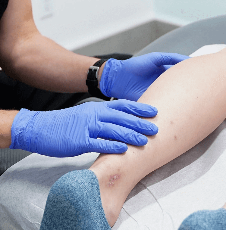 Does spider vein removal really work?