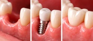 Essential Tips for Choosing the Best Tooth Implants Clinic in Abu Dhabi