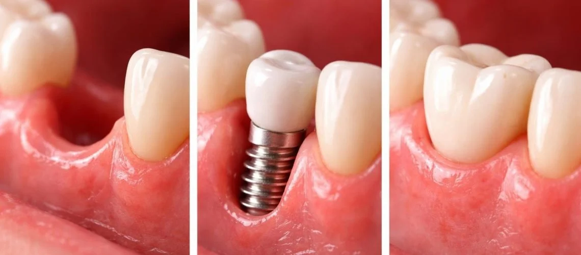 tooth implants clinic